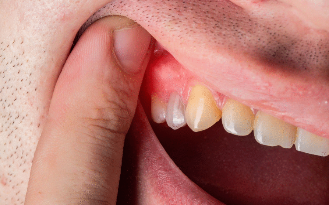 Dental Abscess Symptoms: When Tooth Pain, Swelling, or Infection Needs Urgent Care in McKinney